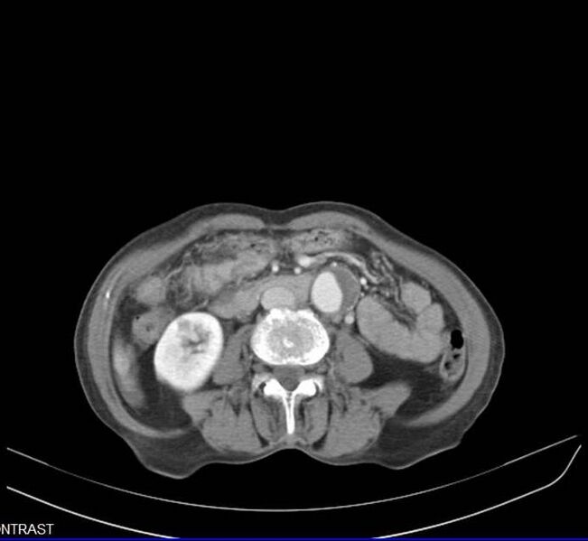 File:Aortic dissection - Stanford type A (Radiopaedia 20760-20675 C 4).jpg