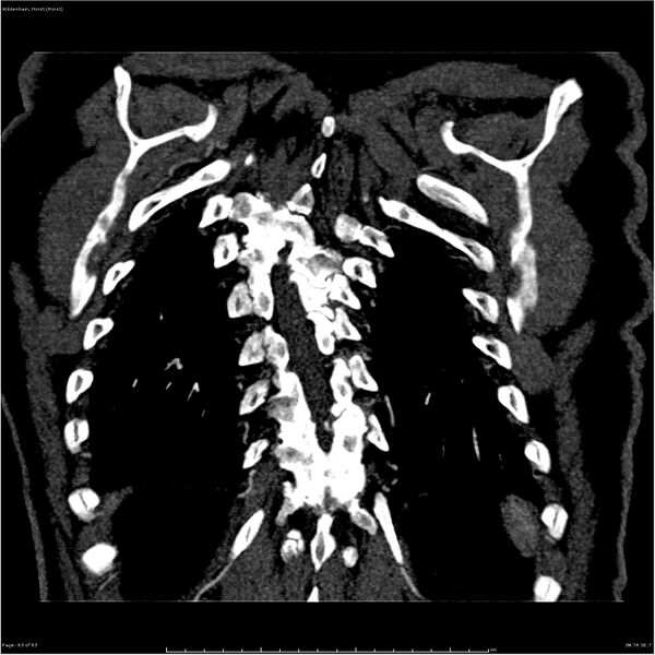 File:Aortic dissection - Stanford type A (Radiopaedia 26183-26315 A 63).jpg