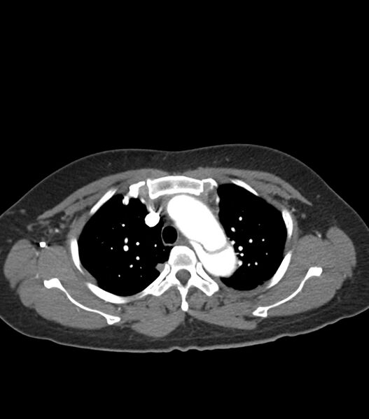 File:Aortic dissection with renal ischemia (Radiopaedia 76573-88338 A 13).jpg