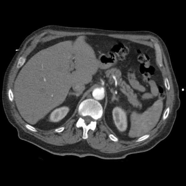 File:Aortic dissection with rupture into pericardium (Radiopaedia 12384-12647 A 54).jpg