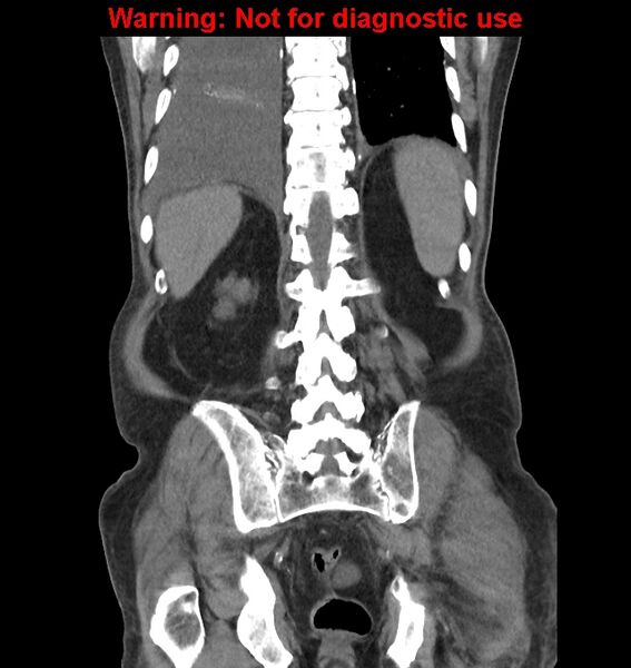 File:Aortic graft infection (Radiopaedia 44979-48907 non-contrast 40).jpg