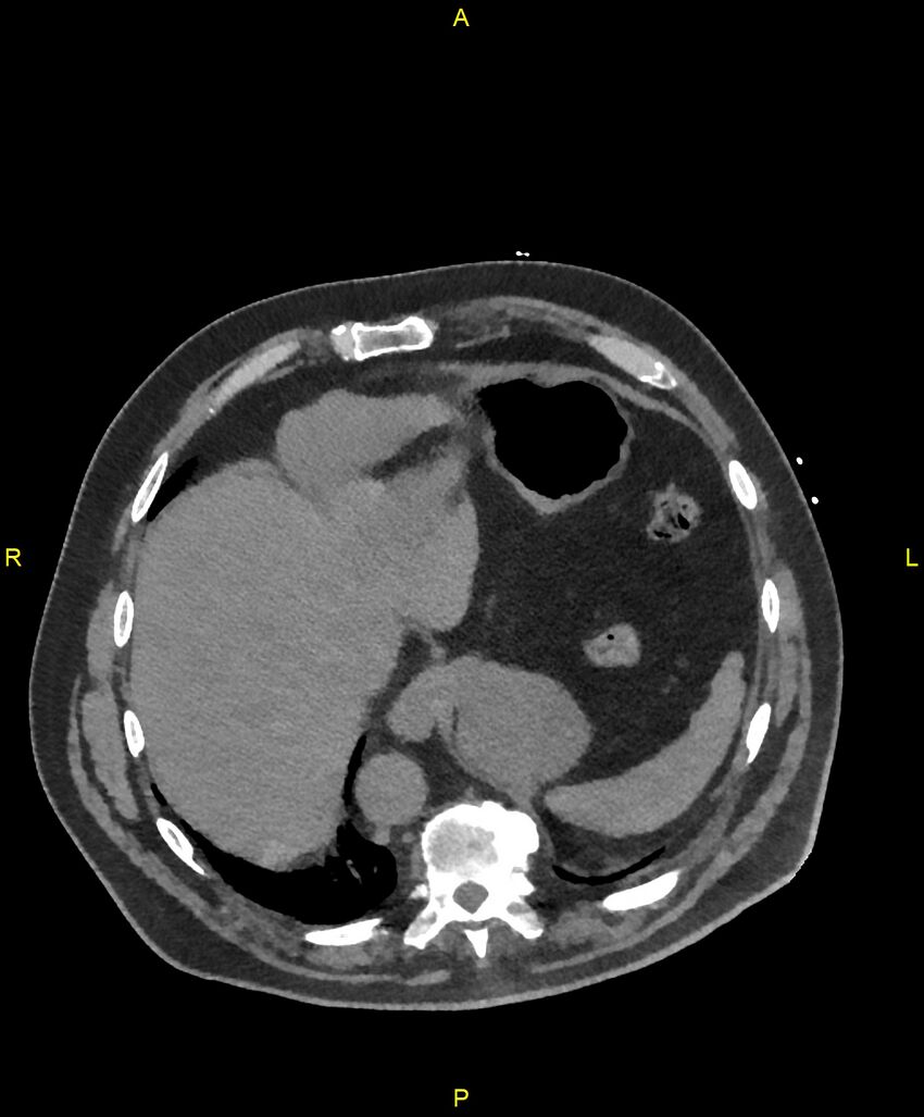 Aortic rupture (Radiopaedia 88822-105594 Axial non-contrast 202).jpg