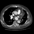 Aorto-coronary bypass graft aneurysms (Radiopaedia 40562-43157 A 61).png