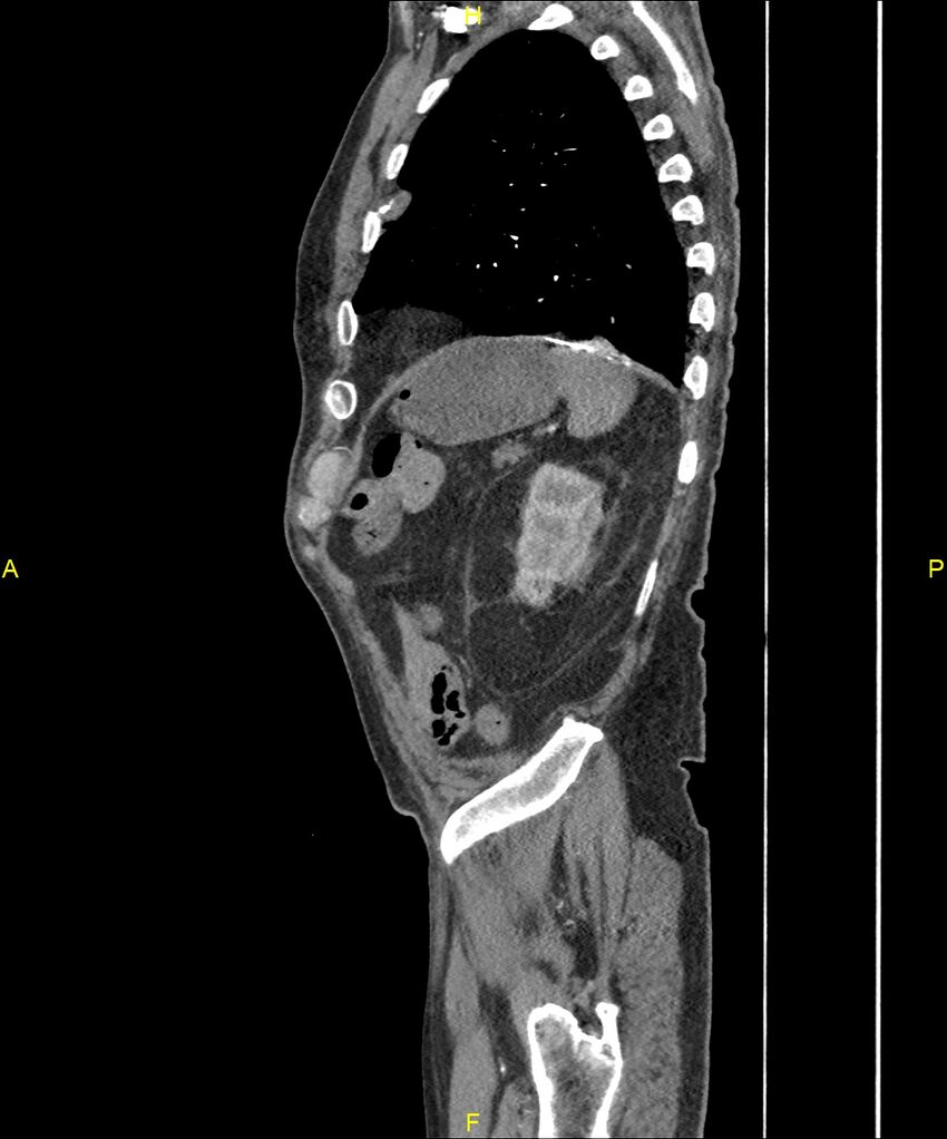 Aortoenteric fistula (Radiopaedia 84308-99603 C 280).jpg