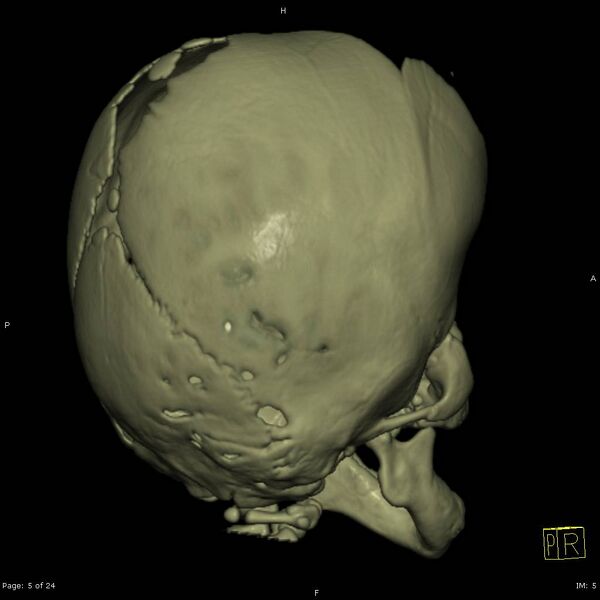File:Apert syndrome with syndactyly (Radiopaedia 10315-10834 3D MPR bone window 5).jpg