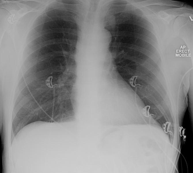 File:Apical pulmonary metastasis (Radiopaedia 46338-50753 Frontal 1).png