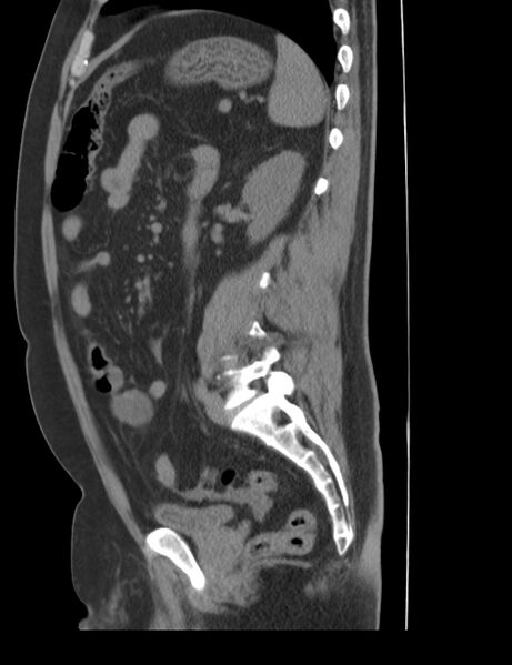 File:Appendicitis and giant appendicolith (Radiopaedia 80251-93588 C 28).jpg