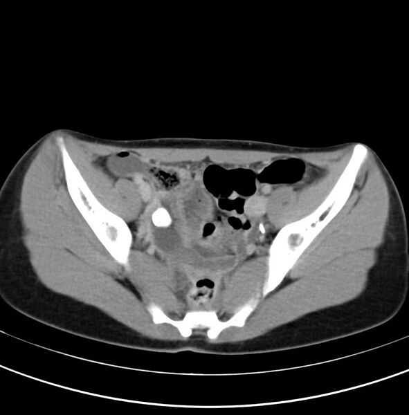 File:Appendicitis and incidental bicornuate uterus (Radiopaedia 22833-22853 Axial C+ delayed 32).jpg