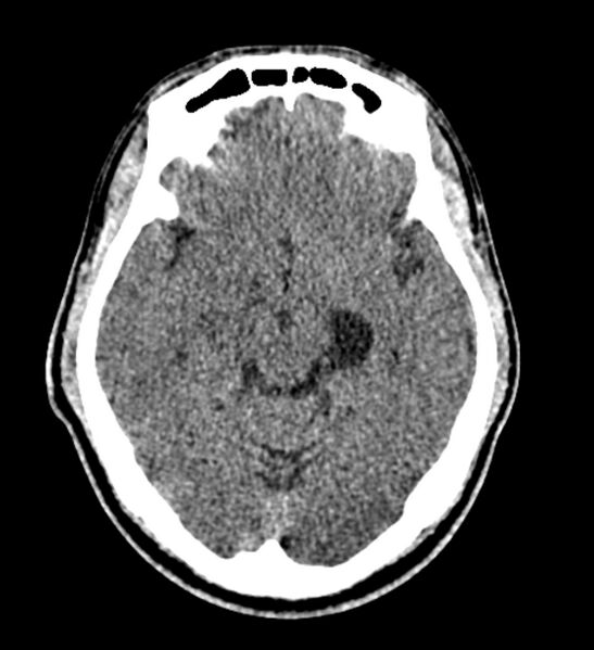 File:Arachnoid cyst of the ambient cistern (Radiopaedia 81301-94986 Axial non-contrast 29).jpg