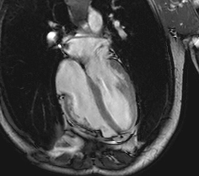 File:Arrhythmogenic right ventricular cardiomyopathy (Radiopaedia 39806-42237 D 56).jpg