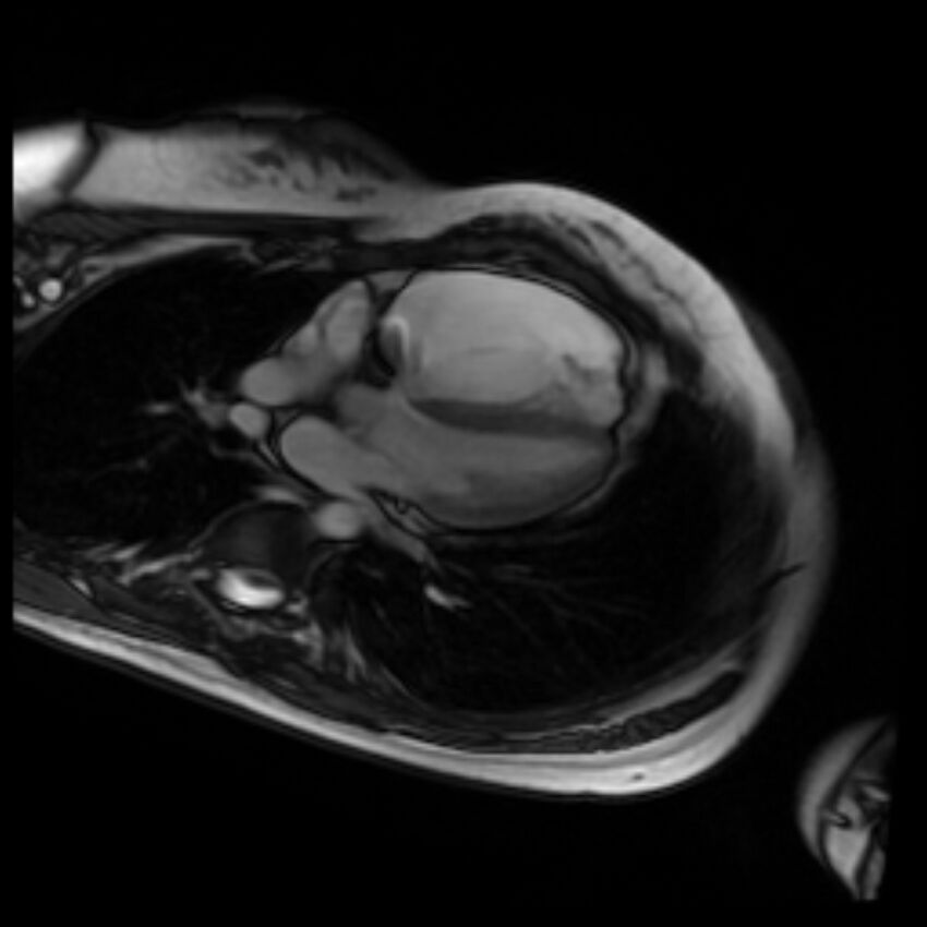 Arrhythmogenic right ventricular cardiomyopathy (Radiopaedia 87505-103850 4ch Cine SSFP 47).jpg