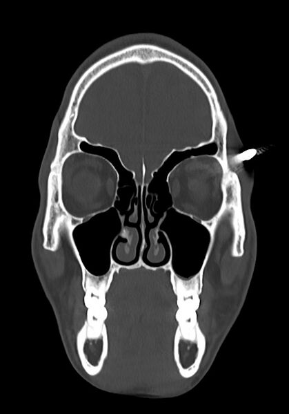 File:Arrow injury to the head (Radiopaedia 75266-86388 Coronal bone window 29).jpg