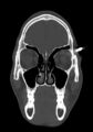 Arrow injury to the head (Radiopaedia 75266-86388 Coronal bone window 29).jpg