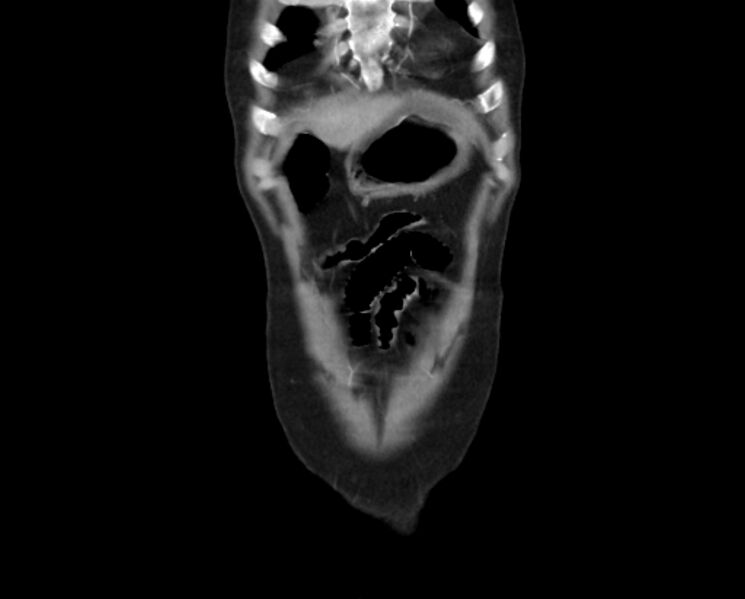File:Arterial occlusive mesenteric ischemia (Radiopaedia 84641-100060 B 5).jpg