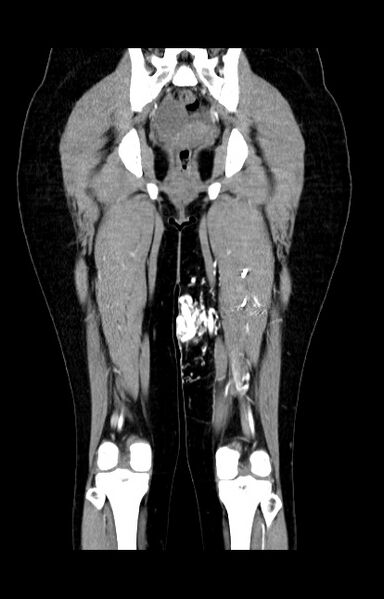 File:Arteriovenous malformation of the thigh (Radiopaedia 14948-14883 C+ arterial phase 16).jpg