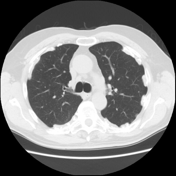 File:Asbestos-related pleural plaques (Radiopaedia 39069-41255 Axial lung window 26).jpg