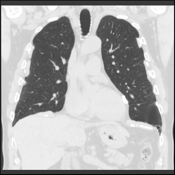 File:Asbestos-related pleural plaques (Radiopaedia 39069-41255 Coronal lung window 53).jpg