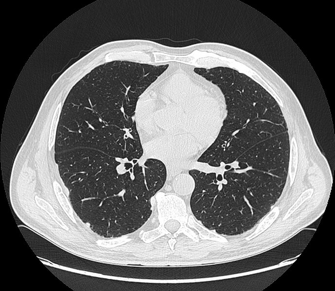 File:Asbestos pleural placques (Radiopaedia 57905-64872 Axial lung window 141).jpg