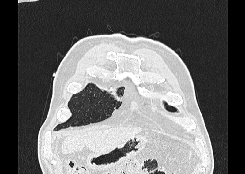 File:Asbestos pleural placques (Radiopaedia 57905-64872 Coronal lung window 15).jpg
