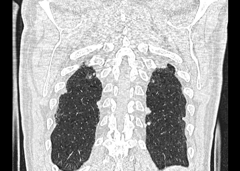 File:Asbestos pleural placques (Radiopaedia 57905-64872 Coronal lung window 260).jpg