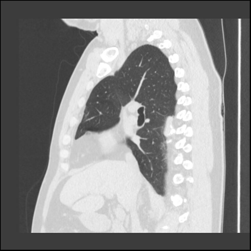 Asbestosis (Radiopaedia 45002-48961 Sagittal lung window 80).jpg