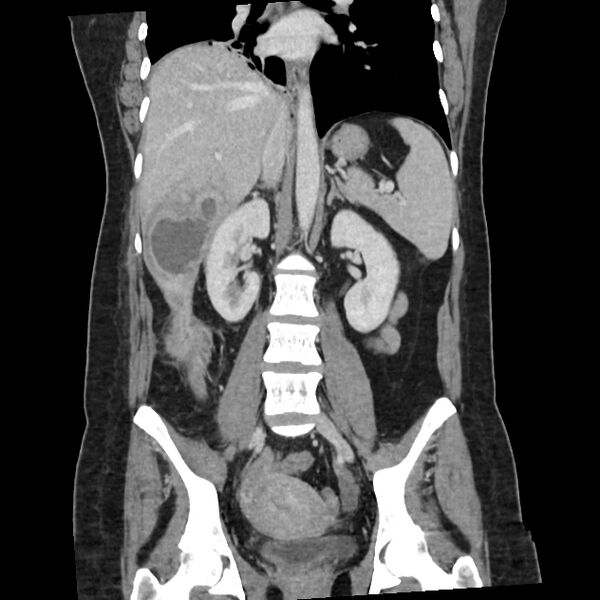 File:Ascending retrocecal appendicitis with liver abscesses (Radiopaedia 60066-67615 C 15).jpg