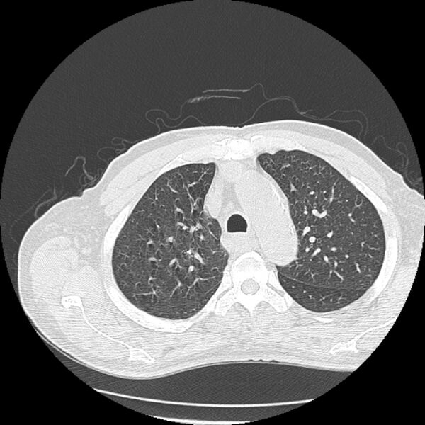 File:Aspergilloma (Radiopaedia 44592-48327 Axial lung window 19).jpg