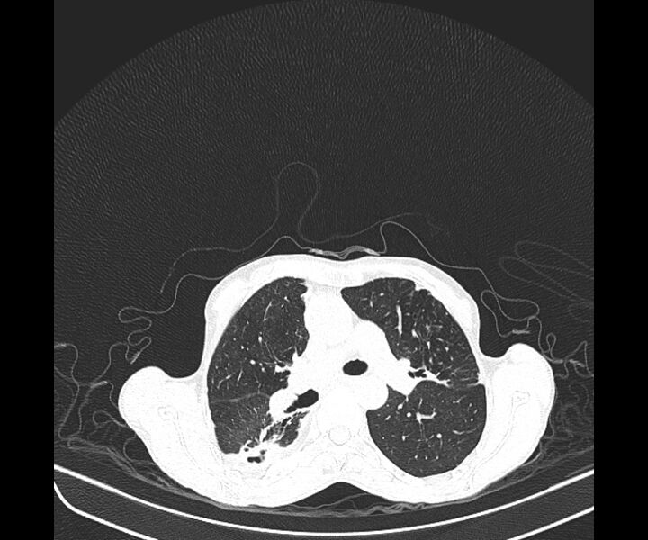 File:Aspergillomas (Radiopaedia 66779-76110 Axial lung window 21).jpg