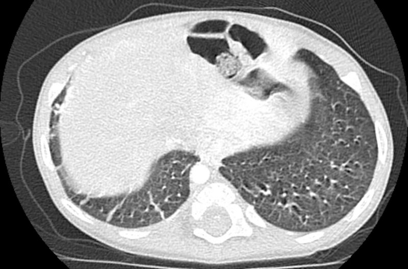 File:Asplenia syndrome (Radiopaedia 73083-83792 Axial lung window 64).jpg
