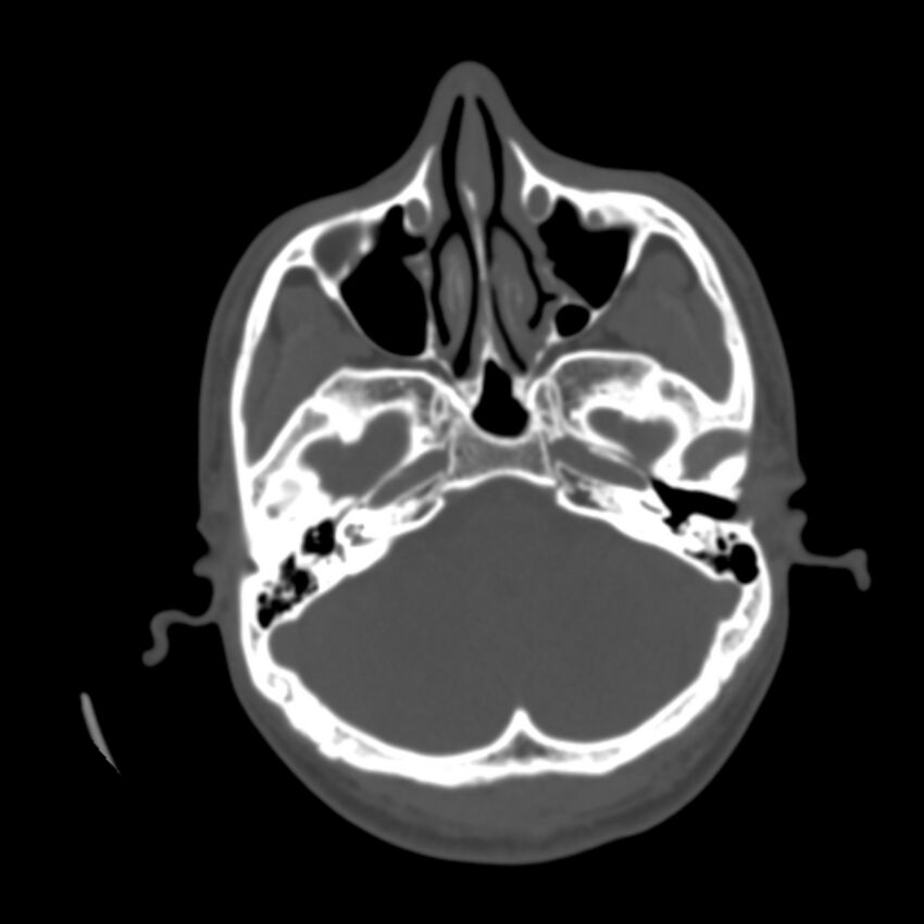 Asymptomatic occipital spur (Radiopaedia 87753-104201 Axial bone window 33).jpg