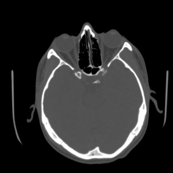File:Asymptomatic occipital spur (Radiopaedia 87753-104201 Axial bone window 63).jpg