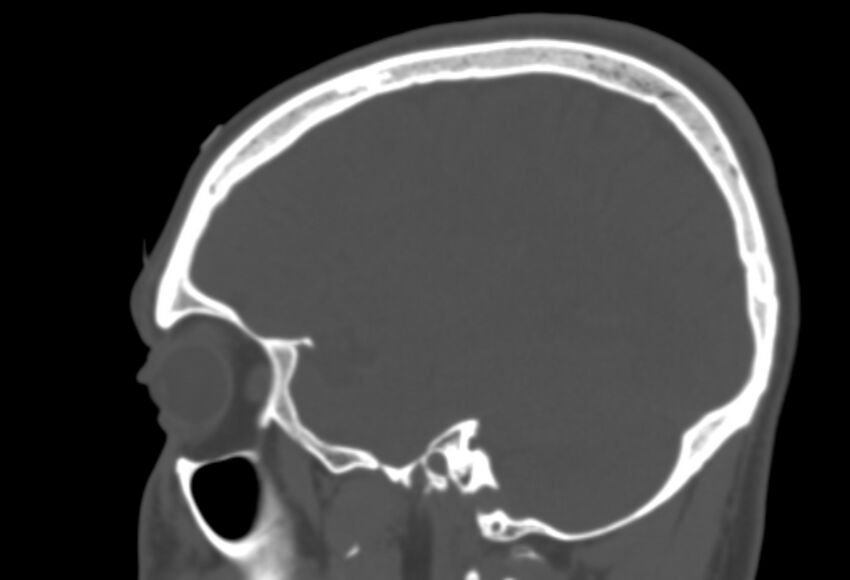 Asymptomatic occipital spur (Radiopaedia 87753-104201 Sagittal bone window 225).jpg