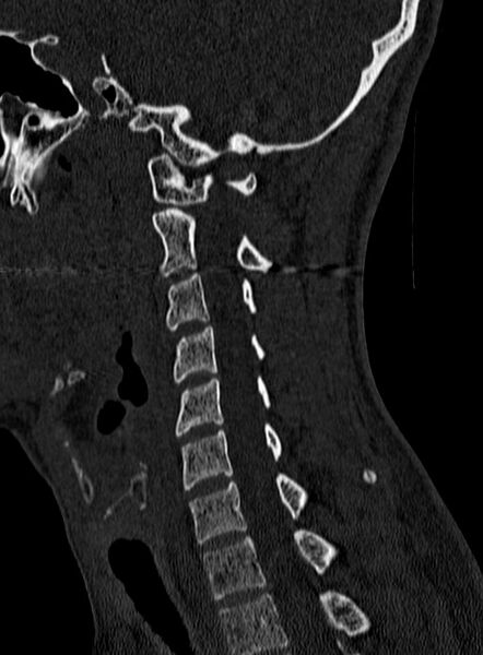 File:Atlantoaxial subluxation (Radiopaedia 44681-48450 Sagittal bone window 98).jpg
