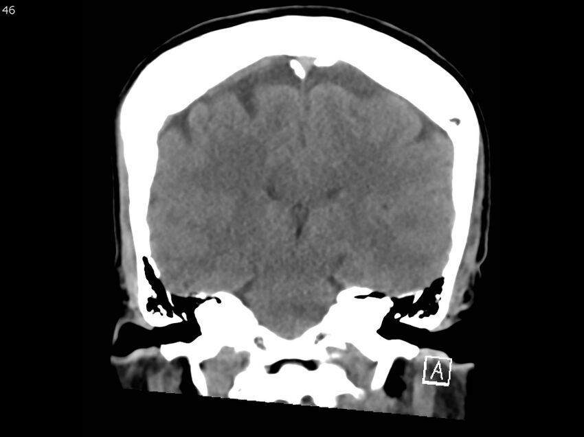 Atypical meningioma - intraosseous (Radiopaedia 64915-73867 B 45).jpg