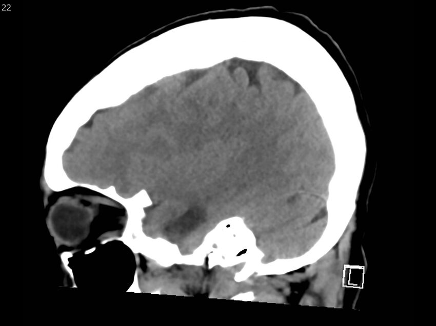 Atypical meningioma - intraosseous (Radiopaedia 64915-73867 C 20).jpg