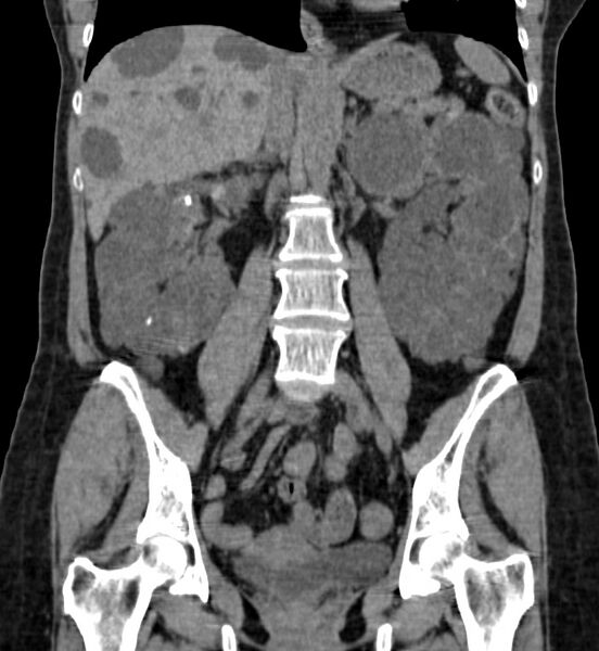 File:Autosomal dominant polycystic kidney disease (Radiopaedia 41918-44922 Coronal non-contrast 25).jpg