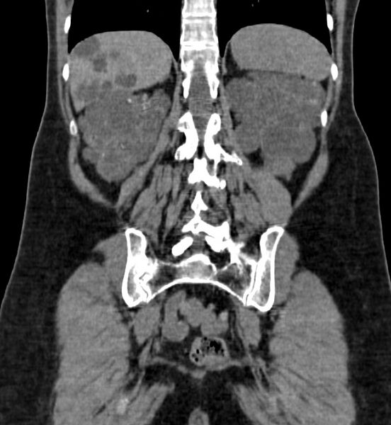 File:Autosomal dominant polycystic kidney disease (Radiopaedia 41918-44922 Coronal non-contrast 39).jpg
