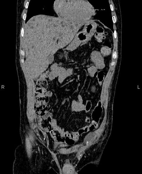 File:Autosomal dominant polycystic kidney disease (Radiopaedia 87830-104287 Coronal non-contrast 14).jpg