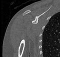 Avulsion fracture - greater tuberosity of humerus (Radiopaedia 71216-81514 Coronal bone window 42).jpg