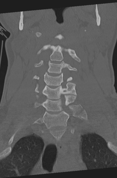 File:Axis peg fracture (type 3) and atlas lateral mass (type 4) fracture (Radiopaedia 37474-39324 Coronal bone window 15).png