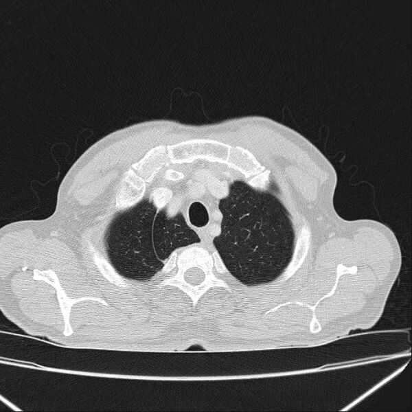 File:Azygos lobe (Radiopaedia 38259-40275 Axial lung window 10).jpg