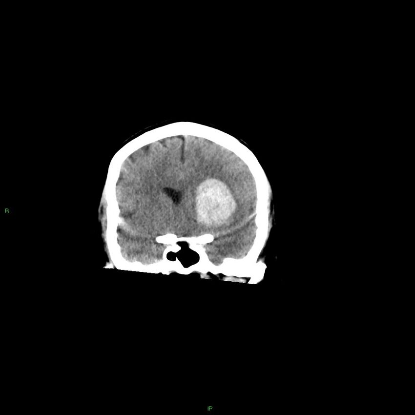 Basal ganglia hemorrhage (Radiopaedia 58349-65472 Coronal non-contrast 43).jpg