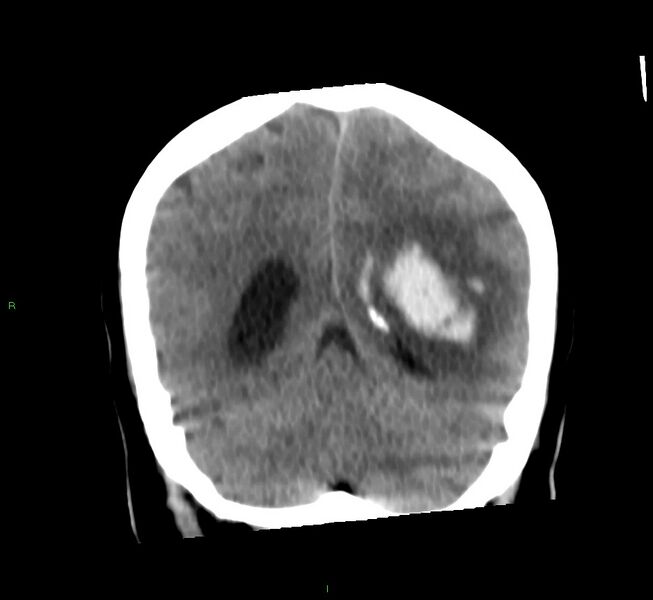 File:Basal ganglia hemorrhage (Radiopaedia 58759-65981 Coronal non-contrast 26).jpg