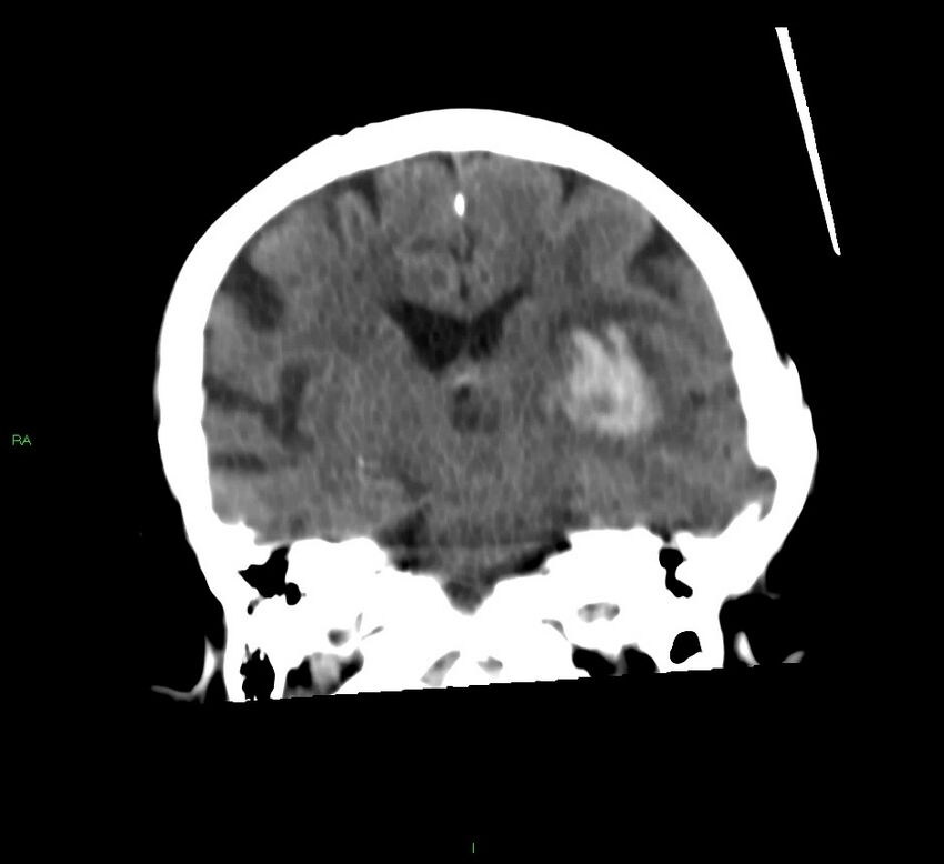 Basal ganglia hemorrhage (Radiopaedia 58790-66024 Coronal non-contrast 30).jpg