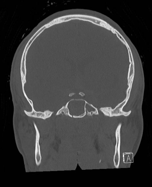 File:Base of skull fracture with bilateral Le Fort fractures (Radiopaedia 47094-51638 Coronal bone window 54).jpg