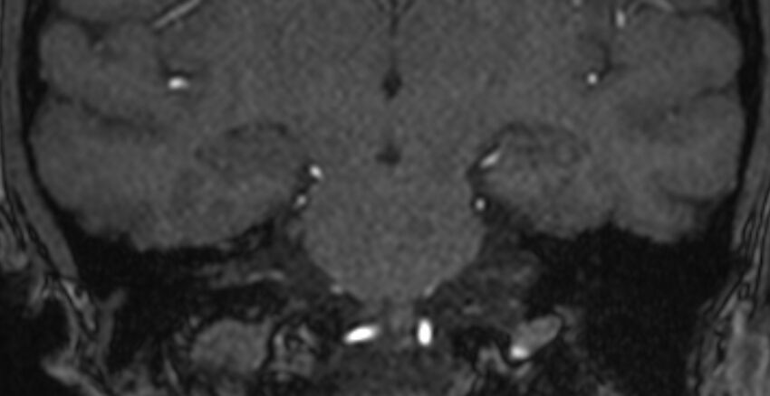 Basilar artery fenestration (Radiopaedia 74537-85455 Coronal MRA TOF 68).jpg