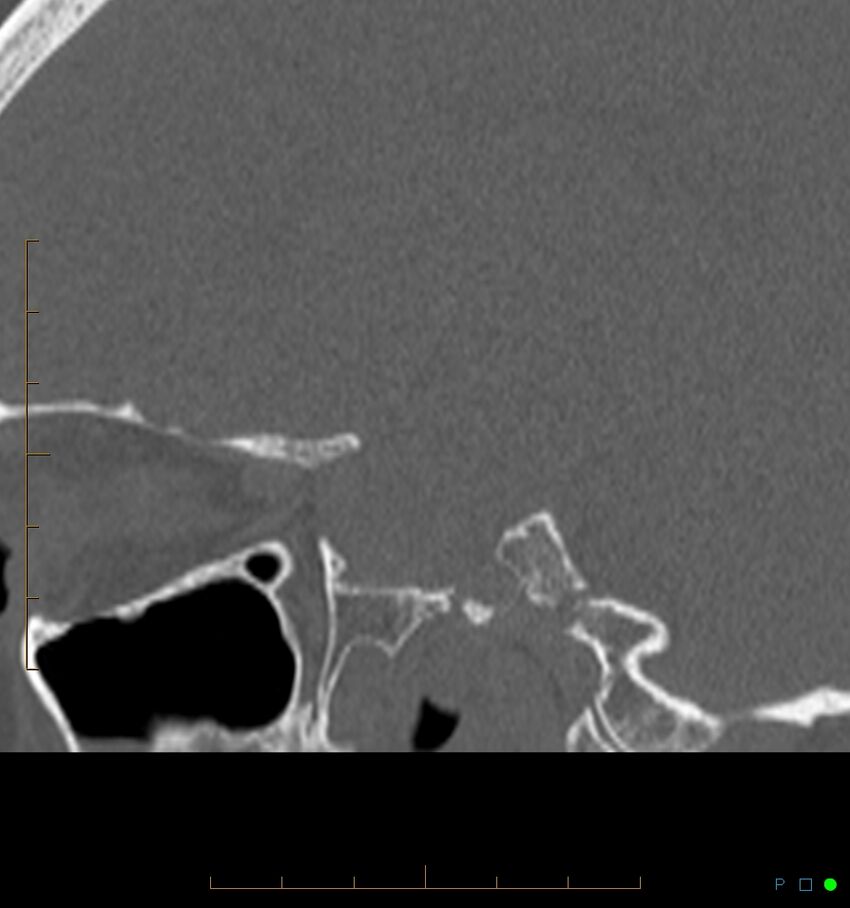 Benign notochordal cell tumor (probable) (Radiopaedia 65475-74546 Sagittal bone window 2).jpg
