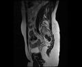 Bicornuate bicollis uterus (Radiopaedia 61626-69616 Sagittal T2 12).jpg