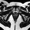 Bicornuate uterus (Radiopaedia 11104-11492 Axial T2 4).jpg