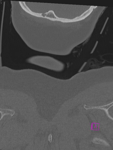 File:Bilateral atlanto-occipital assimilation (Radiopaedia 28350-28603 Coronal bone window 60).jpg